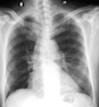 Anterior rib bifurcation (Radiopaedia 85388).png