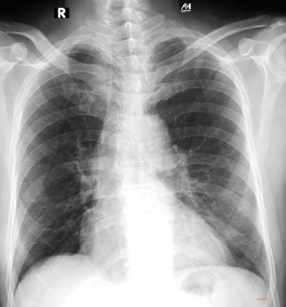 File:Anterior rib bifurcation (Radiopaedia 85388).png