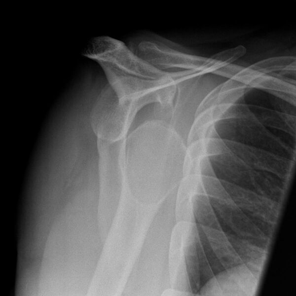 File:Anterior shoulder dislocation (Radiopaedia 2697-6398 Y view 1).jpg