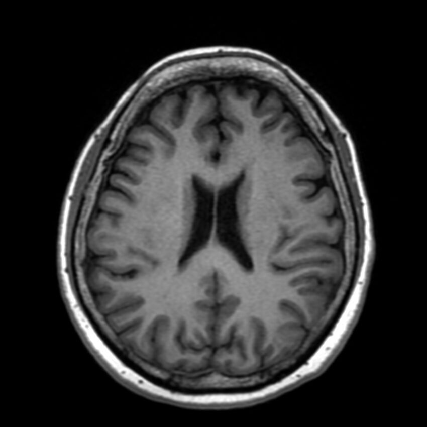 Anti-MOG encephalomyelitis (Radiopaedia 73831-84646 Axial T1 32).jpg