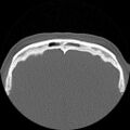 Antrochoanal polyp (Radiopaedia 15098-14982 Axial non-contrast 34).jpg