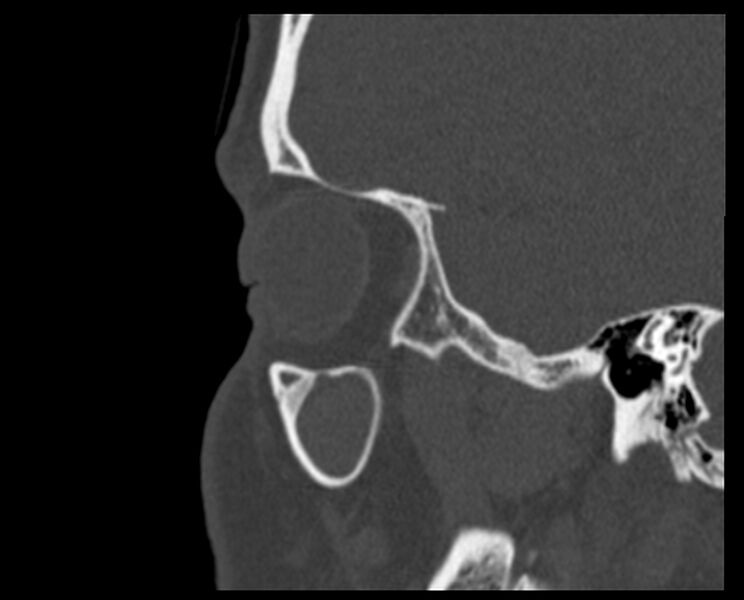 File:Antrochoanal polyp (Radiopaedia 21894-21868 Sagittal bone window 4).jpg