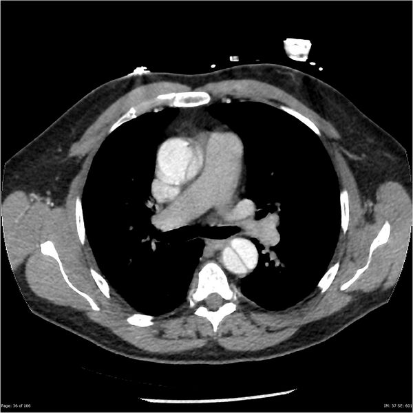 File:Aortic dissection- Stanford A (Radiopaedia 37759-39664 A 27).jpg