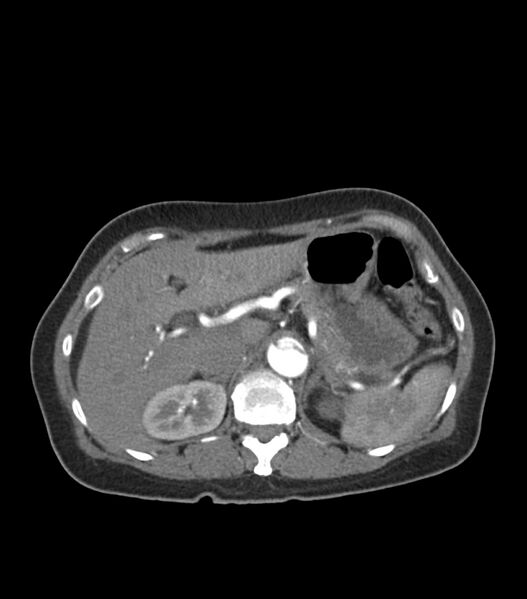 File:Aortic dissection with renal ischemia (Radiopaedia 76573-88338 A 61).jpg