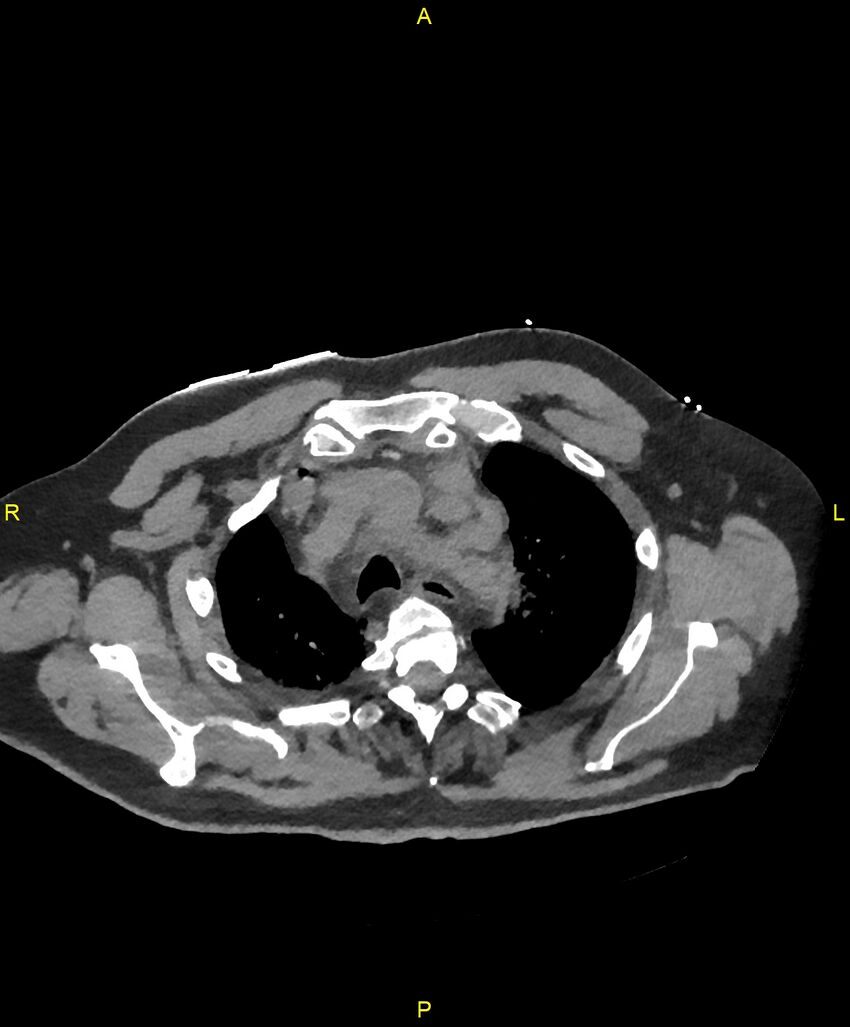 Aortic rupture (Radiopaedia 88822-105594 Axial non-contrast 36).jpg