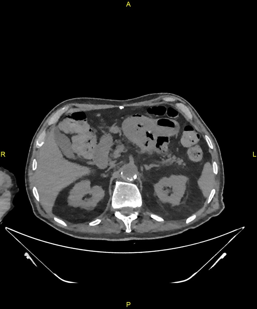 Aortoenteric fistula (Radiopaedia 84308-99603 Axial non-contrast 93).jpg
