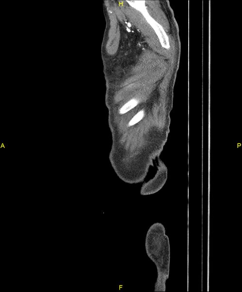 File:Aortoenteric fistula (Radiopaedia 84308-99603 C 333).jpg