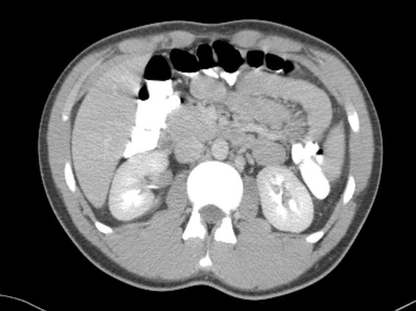 Appendicitis and incidental foregut duplication cyst (Radiopaedia 52962-58916 A 18).jpg