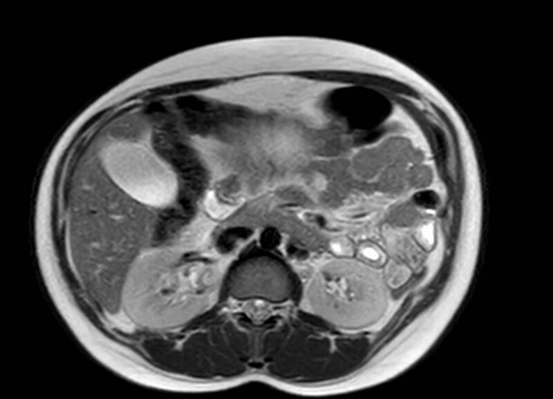 File:Appendicitis in gravida (MRI) (Radiopaedia 89433-106395 Axial T2 24).jpg