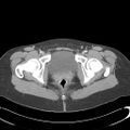 Appendicitis with minimal stranding but appendicolith (Radiopaedia 29035-29397 A 82).jpg
