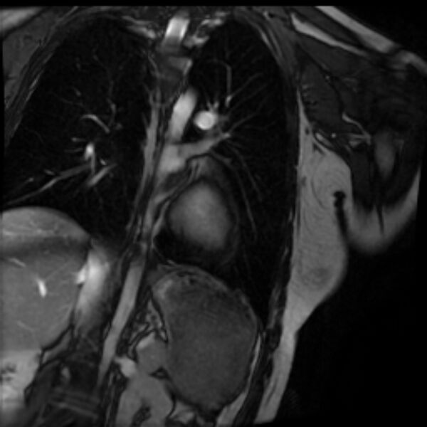 File:Arrhythmogenic right ventricular cardiomyopathy (Radiopaedia 87505-103850 2ch (LV) Cine SSFP 72).jpg