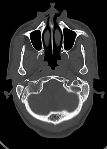 File:Arrow injury to the head (Radiopaedia 75266-86388 Axial bone window 44).jpg