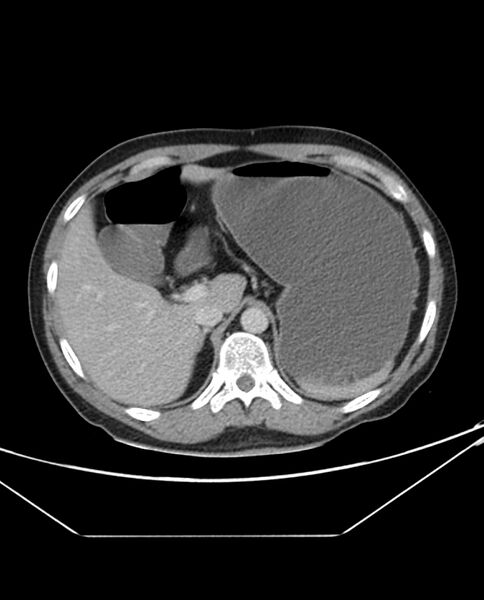 File:Arterial occlusive mesenteric ischemia (Radiopaedia 84641-100054 A 27).jpg