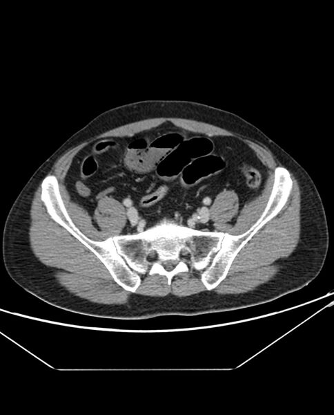 File:Arterial occlusive mesenteric ischemia (Radiopaedia 84641-100054 A 92).jpg