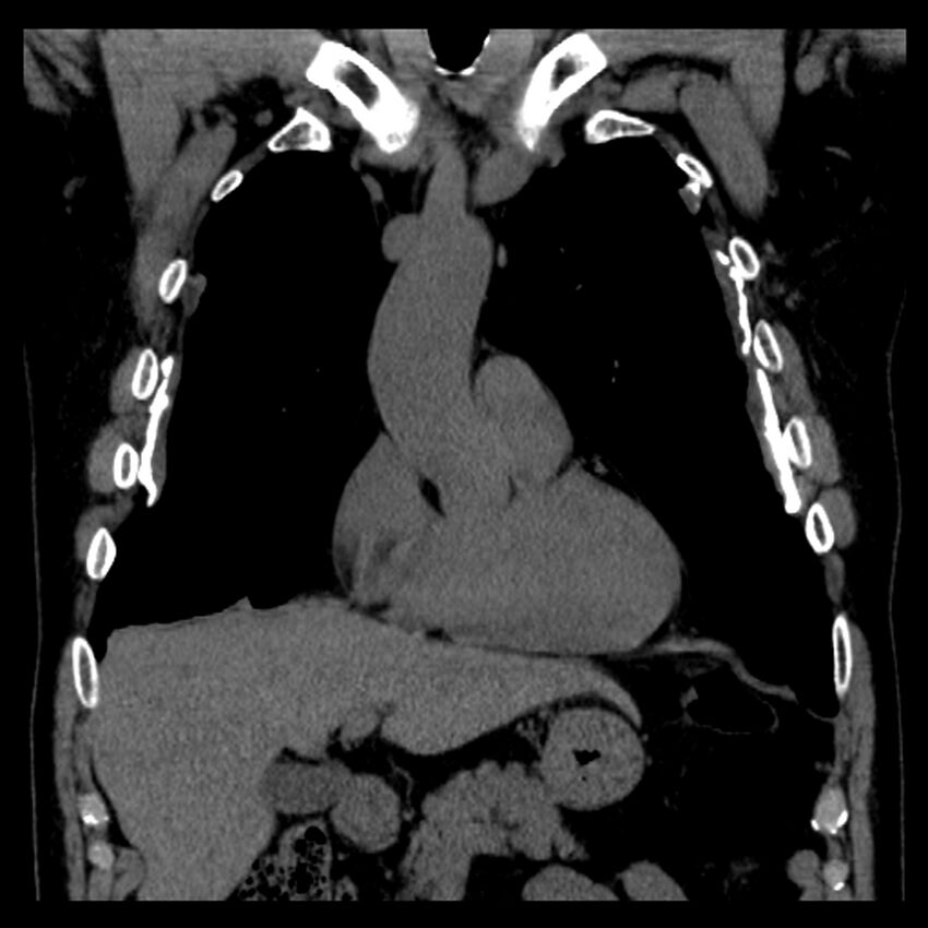 Asbestos-related pleural plaques (Radiopaedia 39069-41255 Coronal non-contrast 61).jpg