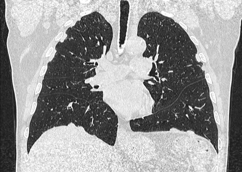Asbestos pleural placques (Radiopaedia 57905-64872 Coronal lung window 142).jpg