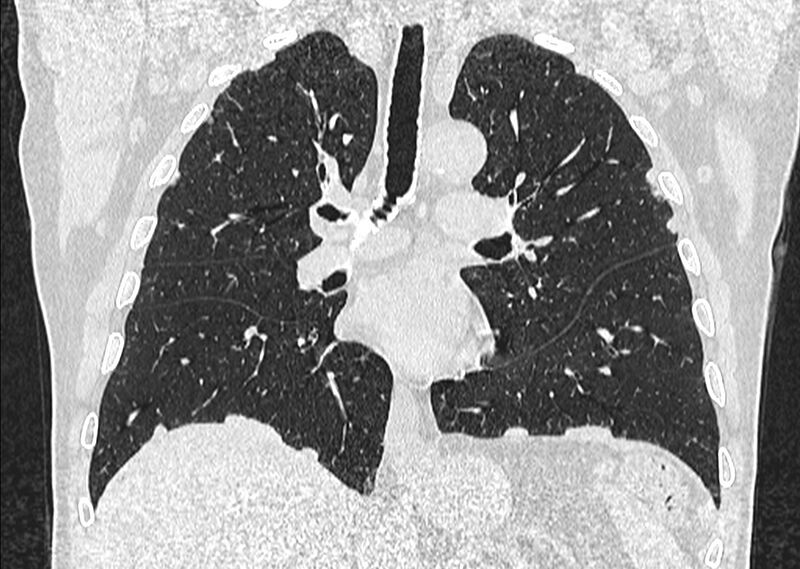 File:Asbestos pleural placques (Radiopaedia 57905-64872 Coronal lung window 150).jpg