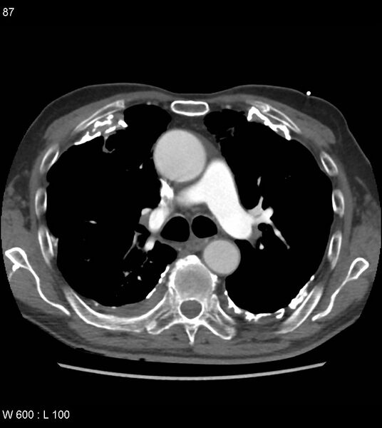 File:Asbestos related lung and pleural disease (Radiopaedia 14377-14301 D 23).jpg
