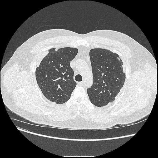 File:Asbestosis (Radiopaedia 45002-48961 Axial lung window 15).jpg