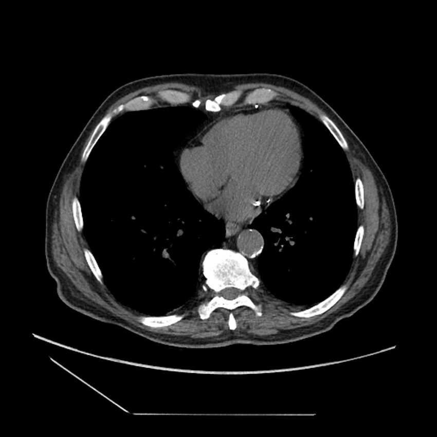 Asbestosis complicated by lung cancer (Radiopaedia 45834-50116 Axial non-contrast 44).jpg