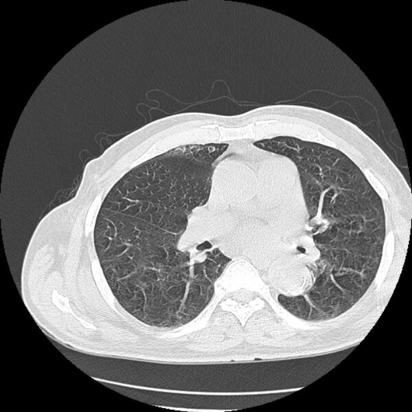 File:Aspergilloma (Radiopaedia 44592-48327 Axial lung window 44).jpg