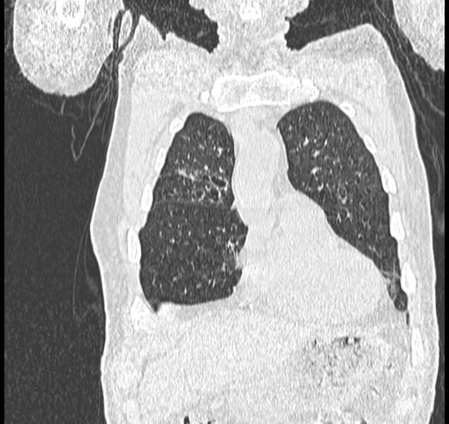 File:Aspergilloma (Radiopaedia 44592-48327 Coronal lung window 21).jpg