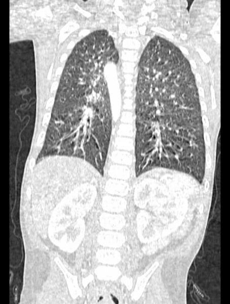 File:Asplenia syndrome (Radiopaedia 73083-83792 Coronal lung window 99).jpg