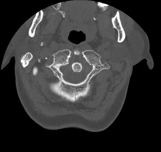 File:Atlanto-occipital assimilation with basilar invagination (Radiopaedia 70122-80188 Axial bone window 20).jpg