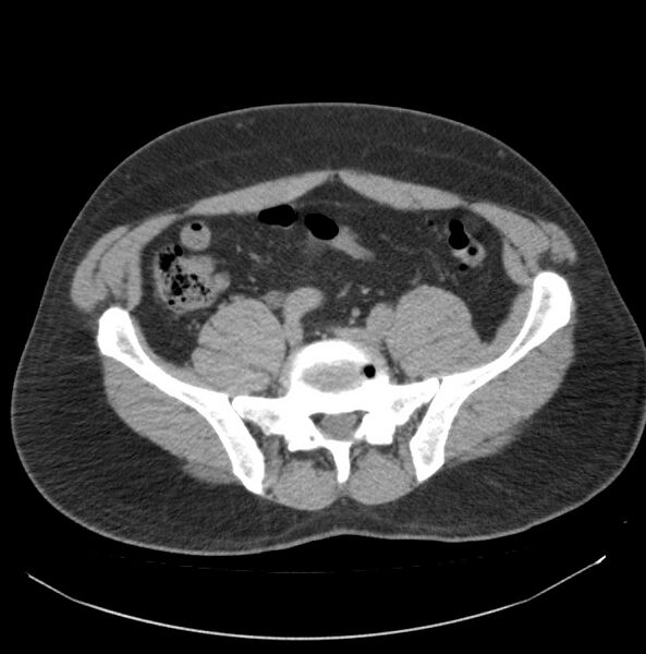 File:Atrophic kidney due to severe chronic obstructive hydronephrosis (Radiopaedia 40828-43474 Axial non-contrast 28).jpg