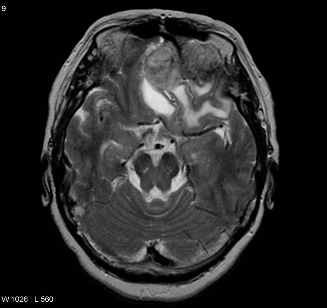 File:Atypical meningioma (WHO grade II) (Radiopaedia 5273-7016 Axial T2 2).jpg
