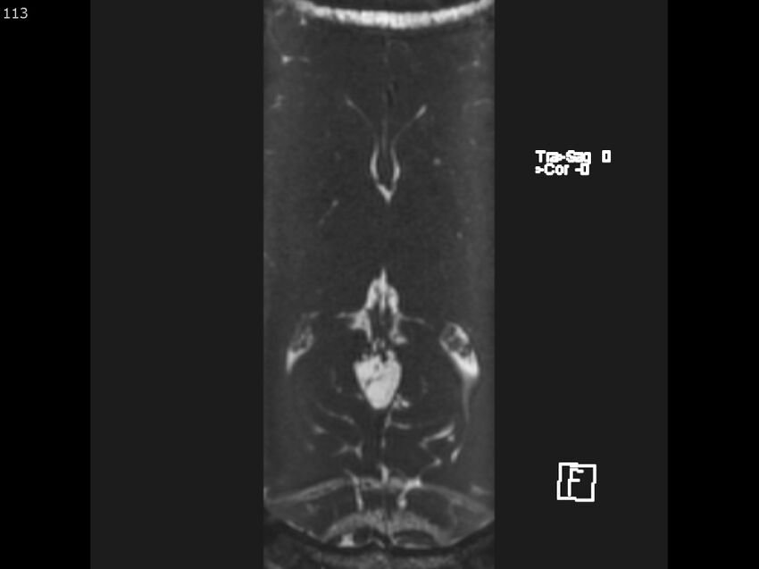 Atypical meningioma - intraosseous (Radiopaedia 64915-74572 Axial CISS 113).jpg