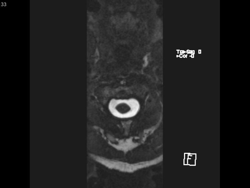 File:Atypical meningioma - intraosseous (Radiopaedia 64915-74572 Axial CISS 33).jpg