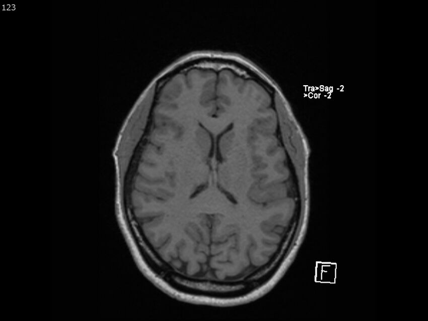 Atypical meningioma - intraosseous (Radiopaedia 64915-74572 Axial T1 123).jpg