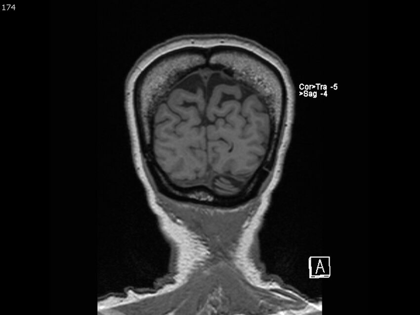 Atypical meningioma - intraosseous (Radiopaedia 64915-74572 Coronal T1 174).jpg