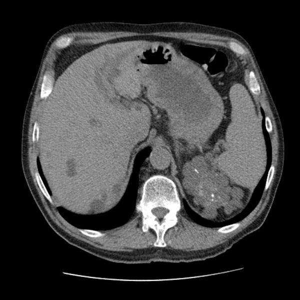 File:Autosomal dominant polycystic kidney disease (Radiopaedia 27851-28094 Axial non-contrast 53).jpg