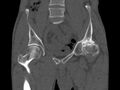 Avascular necrosis of the left hip (Radiopaedia 75068-86125 Coronal bone window 18).jpg