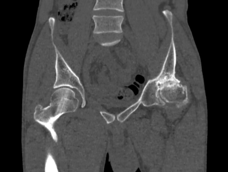 File:Avascular necrosis of the left hip (Radiopaedia 75068-86125 Coronal bone window 18).jpg