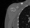 Avulsion fracture - greater tuberosity of humerus (Radiopaedia 71216-81514 Coronal bone window 8).jpg