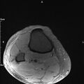 Avulsion fracture of the fibular head (Radiopaedia 74804-85808 Axial PD fat sat 38).jpg