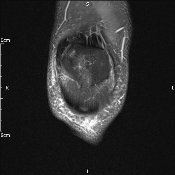 File:Avulsion fracture of the fibular head (Radiopaedia 74804-85808 Coronal PD fat sat 7).jpg