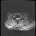 Axis fracture - MRI (Radiopaedia 71925-82375 Axial T2 fat sat 17).jpg