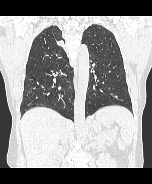 File:Azygos fissure and azygos lobe (Radiopaedia 41841-44832 Coronal lung window 13).jpg