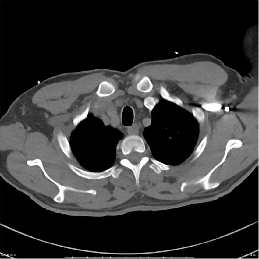 Azygos venous system anatomy (CT pulmonary angiography) (Radiopaedia 25928-26077 Axial C+ CTPA 12).jpg