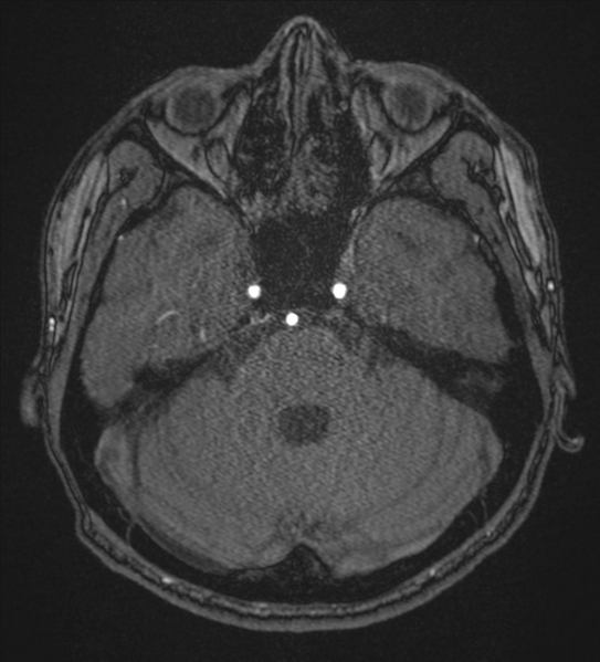 File:Basal ganglia subacute infarct (Radiopaedia 80201-93521 Axial MRA 24).png