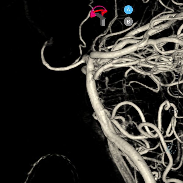 File:Basilar artery perforator aneurysm (Radiopaedia 82455-97734 3D view left VA 24).jpg