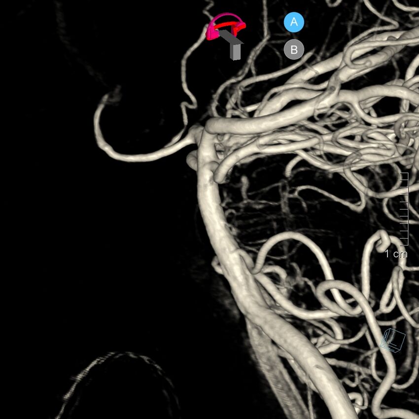 Basilar artery perforator aneurysm (Radiopaedia 82455-97734 3D view left VA 24).jpg