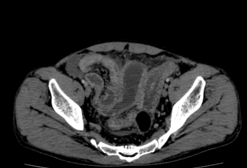 File:Behçet's disease- abdominal vasculitis (Radiopaedia 55955-62570 A 77).jpg