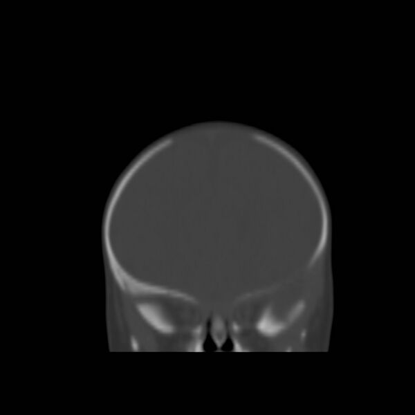 File:Bilateral cephalohematomas and subdural hematomas (Radiopaedia 26778-26929 Coronal bone window 2).jpg