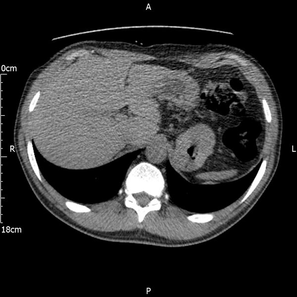 File:Bilateral medullary nephrocalcinosis with ureteric calculi (Radiopaedia 71269-81569 Axial non-contrast 15).jpg