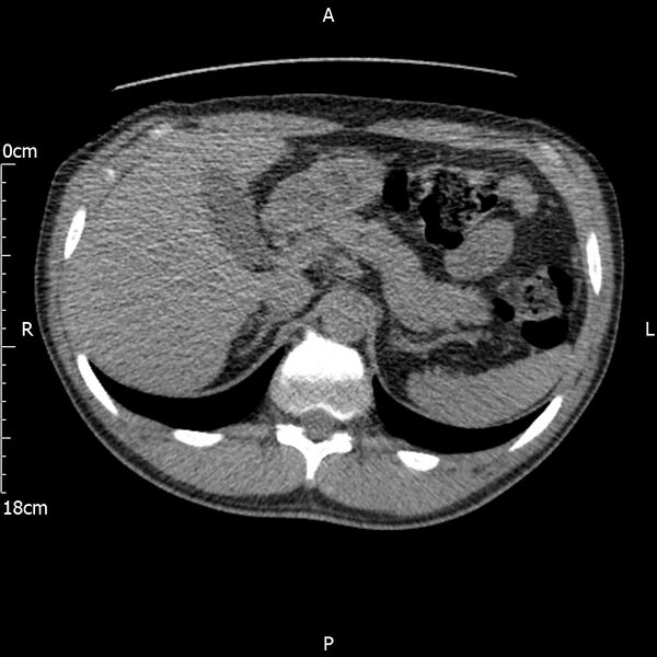 File:Bilateral medullary nephrocalcinosis with ureteric calculi (Radiopaedia 71269-81569 Axial non-contrast 24).jpg